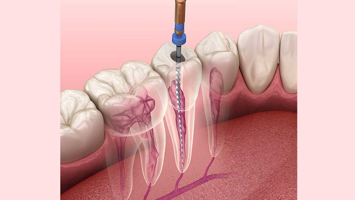 Endodoncija