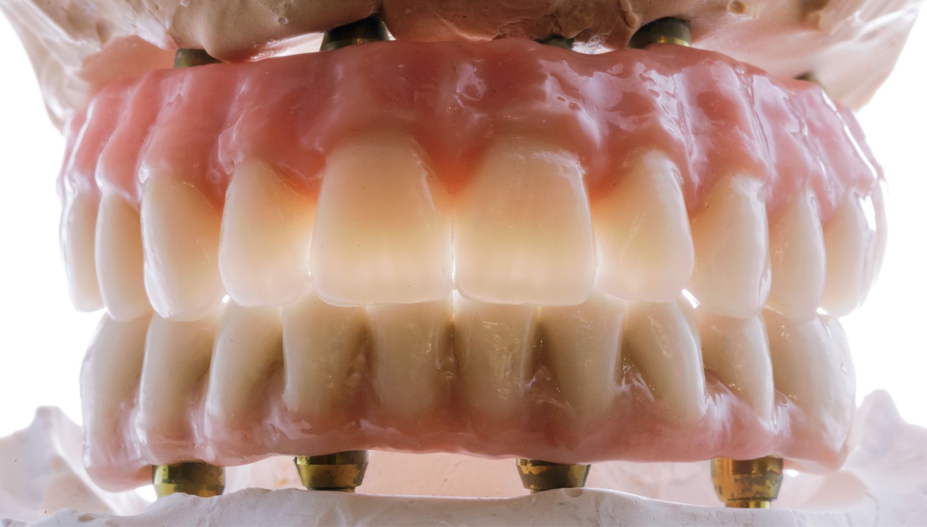 All-on-4 vs. All-on-6 – Koji je zahvat bolji za vas?