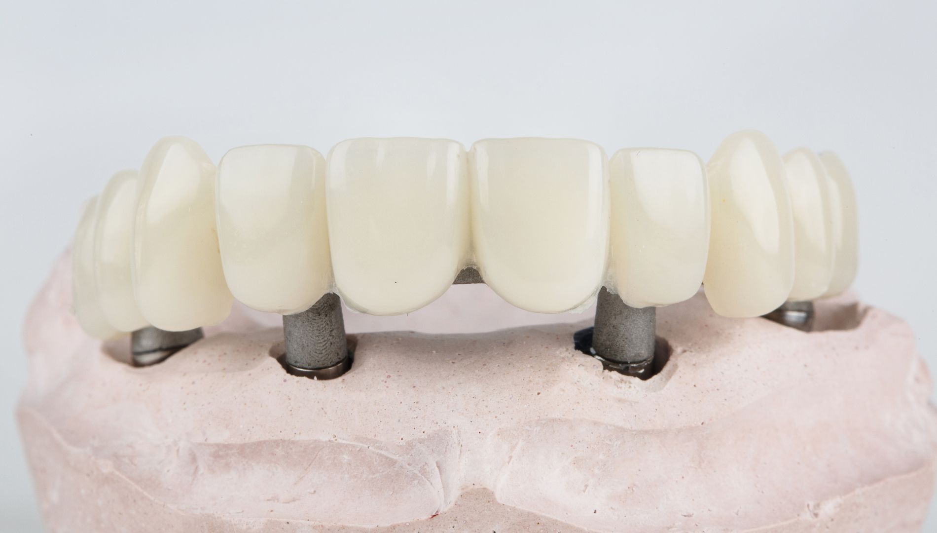 Najčešće greške kod održavanja fiksnih mostova na implantatima