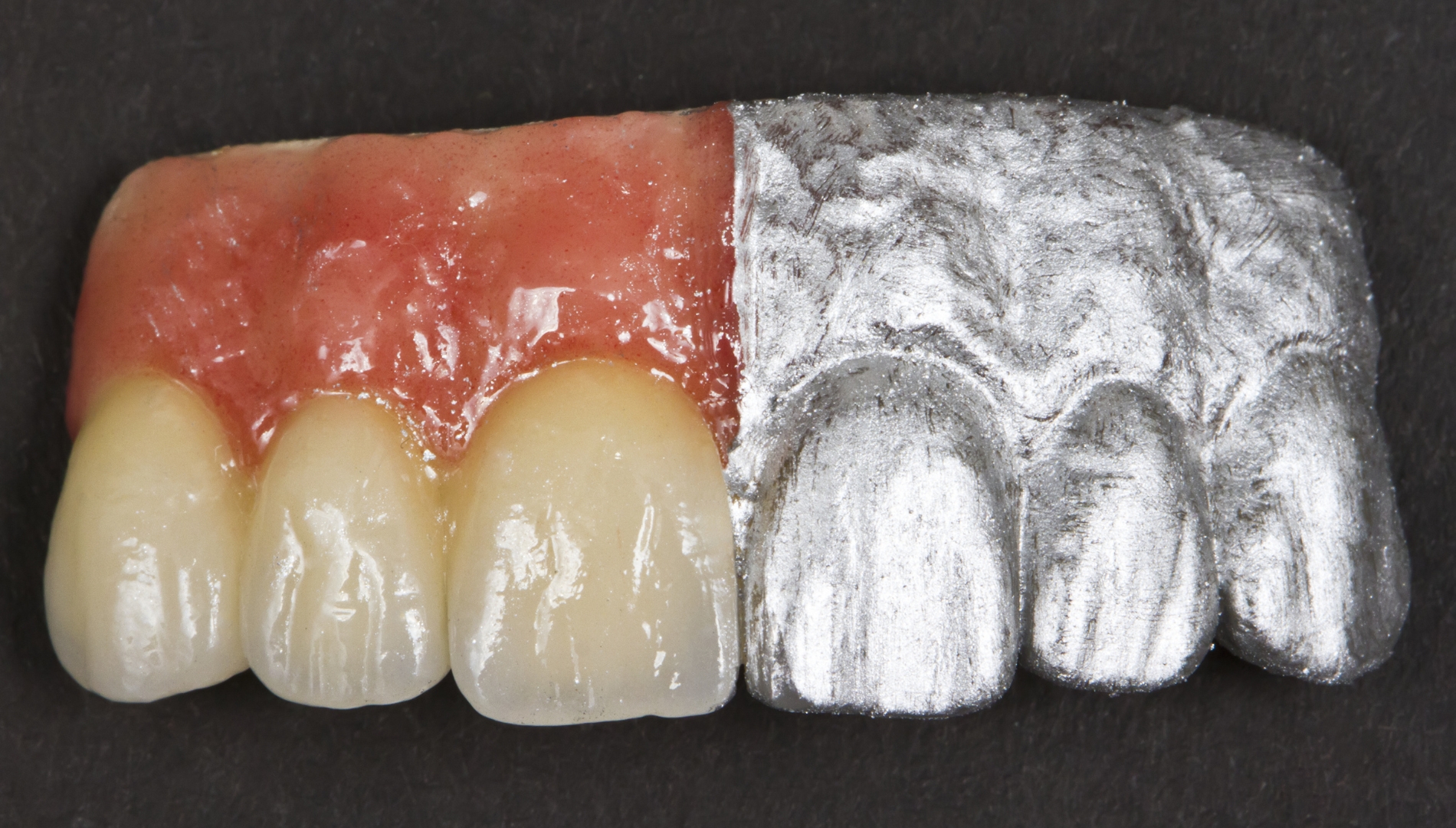 Metal-keramika vs. cirkonij – koju krunicu odabrati?