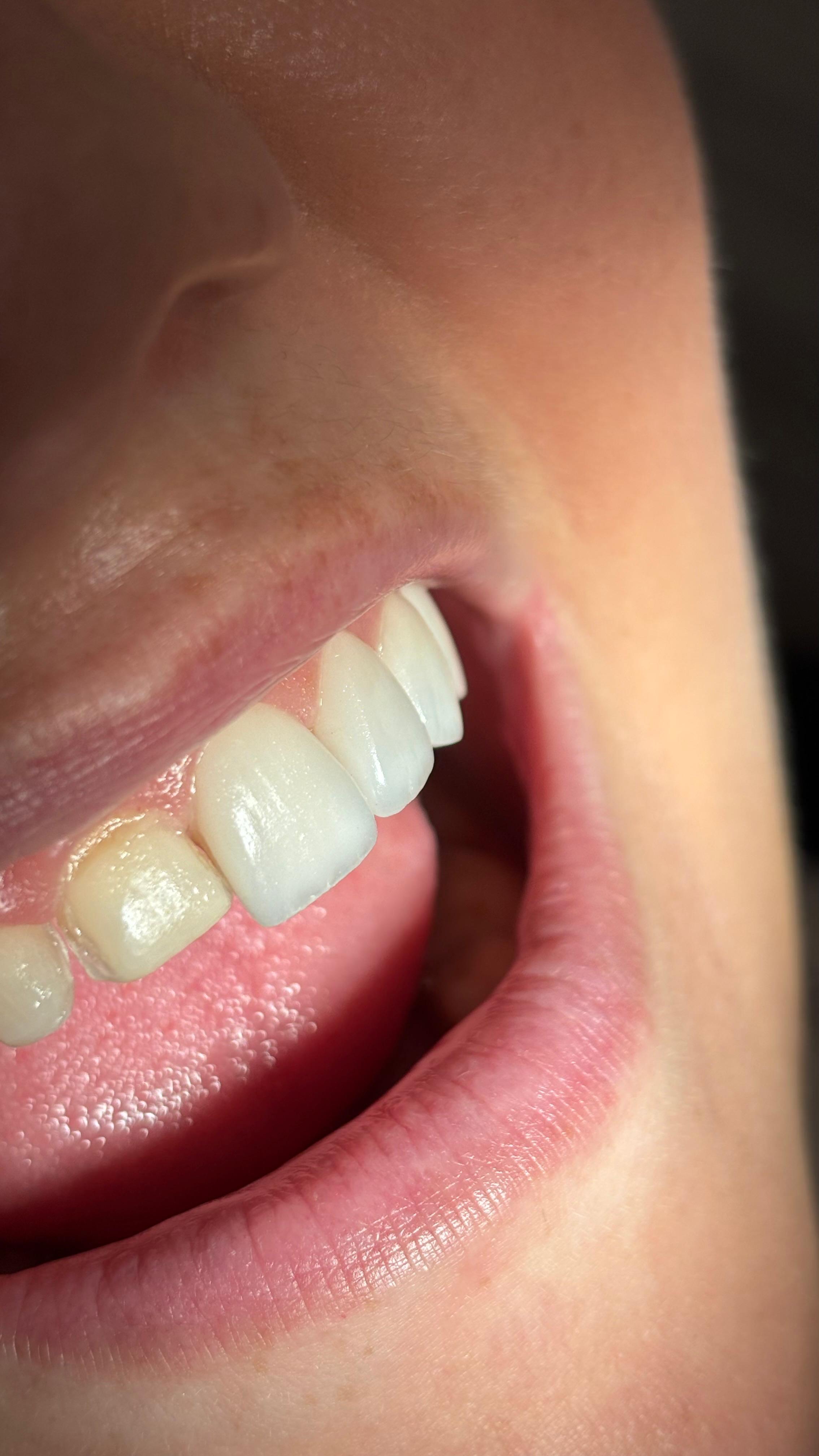 Kako izgleda postupak izrade ljuskica?